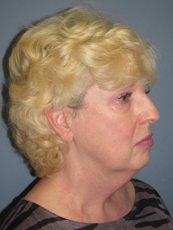 Chemical Peel - Blue Peel 956781