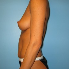 Breast Augmentation before 3665685