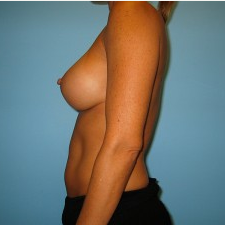 Breast Augmentation after 3665685