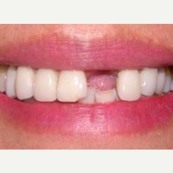 Dental Crown before 1784334