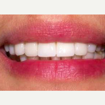 Dental Crown after 1784334