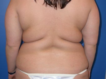 liposuction and buttocks fat grafting before 491529