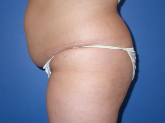 liposuction and buttocks fat grafting 491529