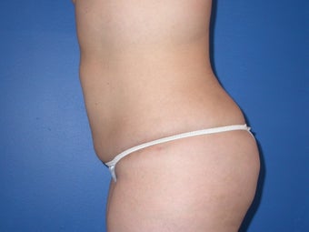 liposuction and buttocks fat grafting 491529