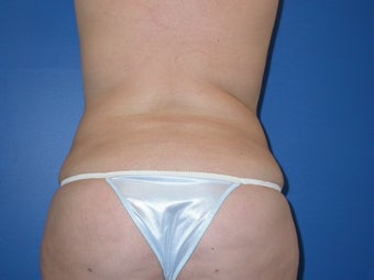 liposuction and buttocks fat grafting after 491529
