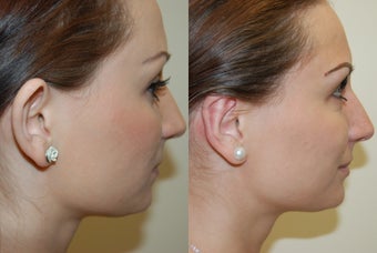 Otoplasty Surgery before 1075798