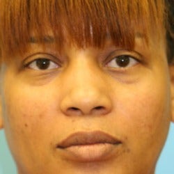 African American Rhinoplasty before 1675635