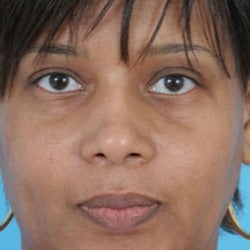 African American Rhinoplasty after 1675635
