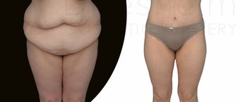 30 year old tummy tuck after 100 pound weight loss before 1127657