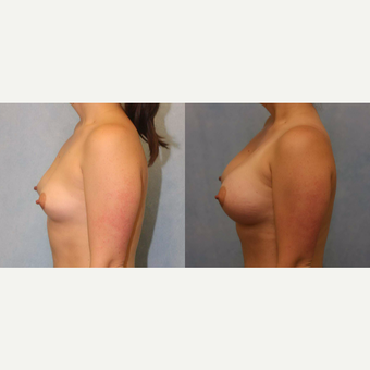 25-34 year old woman treated with Breast Augmentation after 3418477