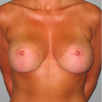 33 year old woman treated with Breast Lift after 3467387