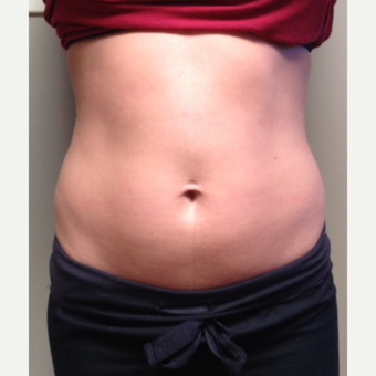 25-34 year old woman treated with UltraShape before 3565786