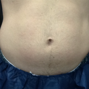 35-44 year old man treated with CoolSculpting before 3140239