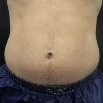 35-44 year old man treated with CoolSculpting after 3140239