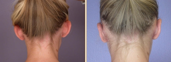 Ear Surgery before 272306