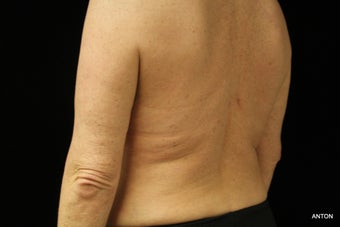 45-54 year old woman treated with SculpSure 3501847