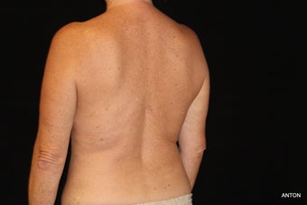 45-54 year old woman treated with SculpSure 3501847