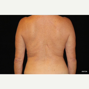 45-54 year old woman treated with SculpSure after 3501847