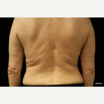 45-54 year old woman treated with SculpSure before 3501847
