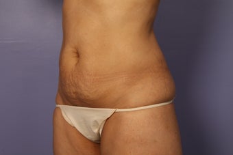 Tummy Tuck and liposuction before 687601