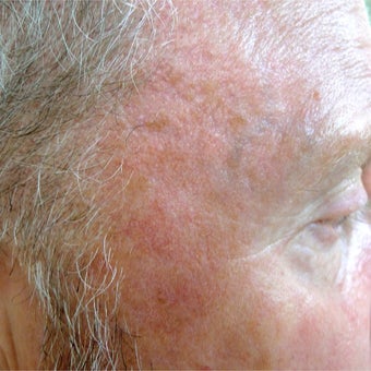 Extensive sun damage treated with Photodynamic Therapy after 1769752