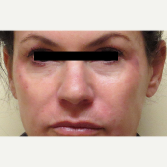 45-54 year old woman treated with Voluma after 3210801