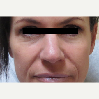 45-54 year old woman treated with Voluma before 3210801