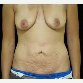 25-34 year old woman treated with Mommy Makeover before 3318655