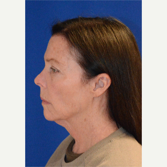 65-74 year old woman with full facial rejuvenation (face, neck, brow lift, upper eyelids) before 3621688