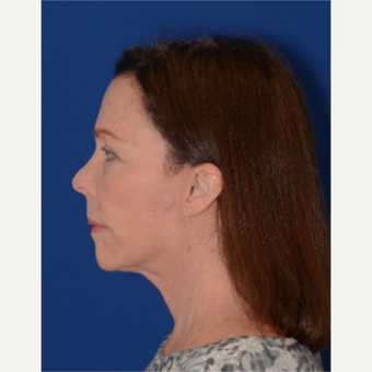 65-74 year old woman with full facial rejuvenation (face, neck, brow lift, upper eyelids) after 3621688