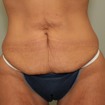 25-34 year old woman treated with Tummy Tuck before 3069709