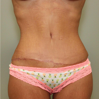 25-34 year old woman treated with Tummy Tuck after 3069709