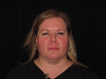 42 year old female for frown lines after 1389552