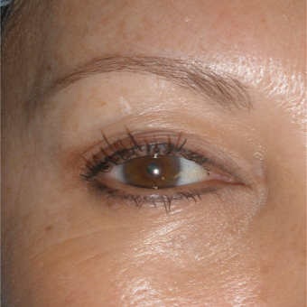 35-44 year old woman treated with Permanent Makeup before 2753794