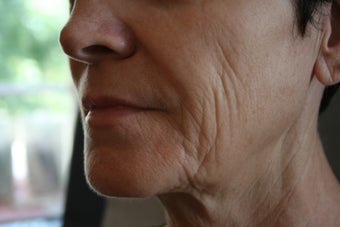 63 Year Old Female 1st treatment with Sculptra Aesthetic before 915996