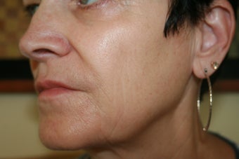 63 Year Old Female 1st treatment with Sculptra Aesthetic after 915996