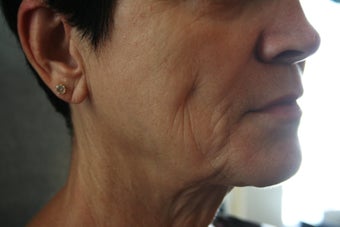 63 Year Old Female 1st treatment with Sculptra Aesthetic 915996