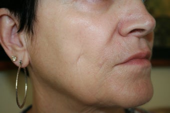 63 Year Old Female 1st treatment with Sculptra Aesthetic 915996
