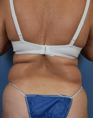 55-64 year old woman treated with Liposuction before 3543913
