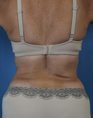55-64 year old woman treated with Liposuction after 3543913