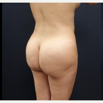 25-34 year old woman treated with Brazilian Butt Lift before 3286159