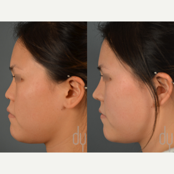 Asian Rhinoplasty before 3116202
