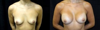30 year old woman treated with Breast Augmentation before 2990224