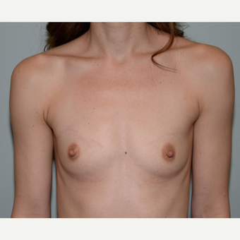 35-44 year old woman treated with Mentor Breast Implants before 3294868
