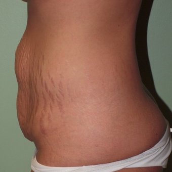 25-34 year old woman treated with Tummy Tuck before 2977749
