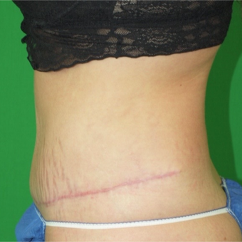 25-34 year old woman treated with Tummy Tuck after 2977749
