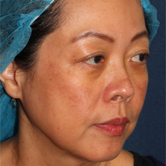 53 year old woman treated with Fraxe Dual Laser and q-switched alexandrite laser one time after 3616568
