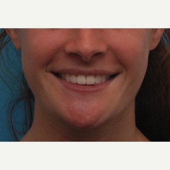 25-34 year old man treated with Orthognathic Surgery after 1733662