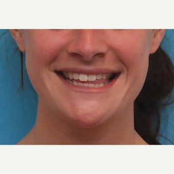 25-34 year old man treated with Orthognathic Surgery before 1733662
