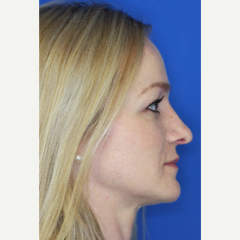 25-34 year old woman treated with Nose Surgery after 3093470